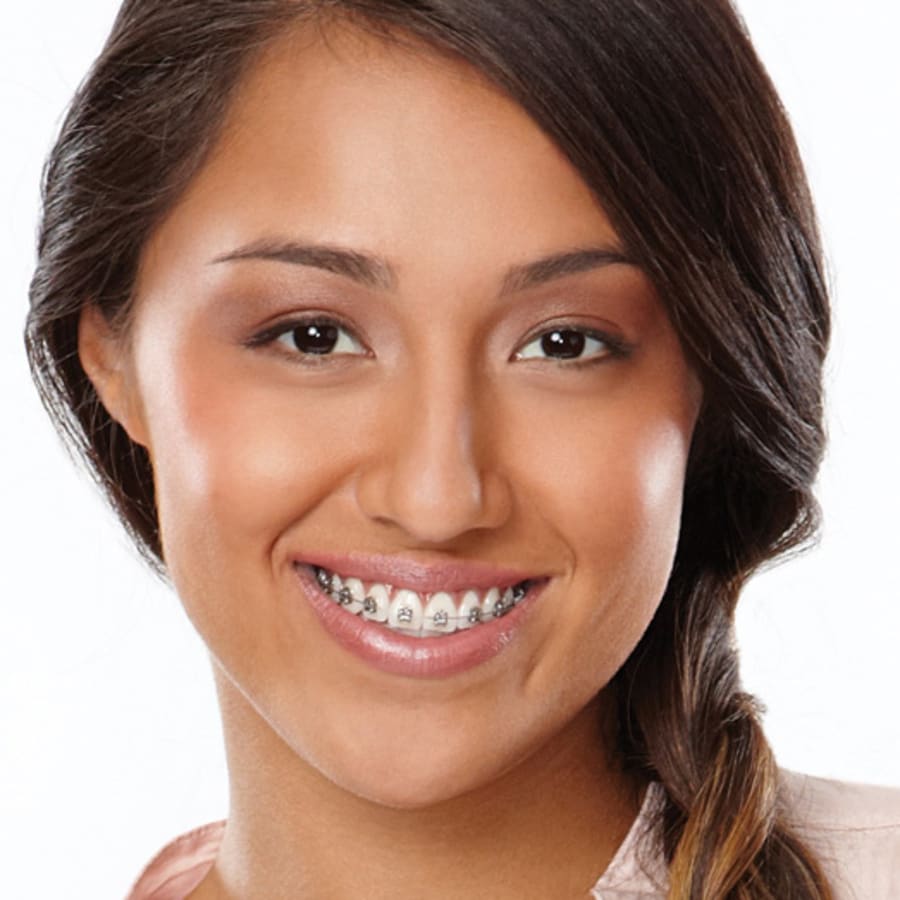 Self-Ligating Braces, Grand Rapids Orthodontist