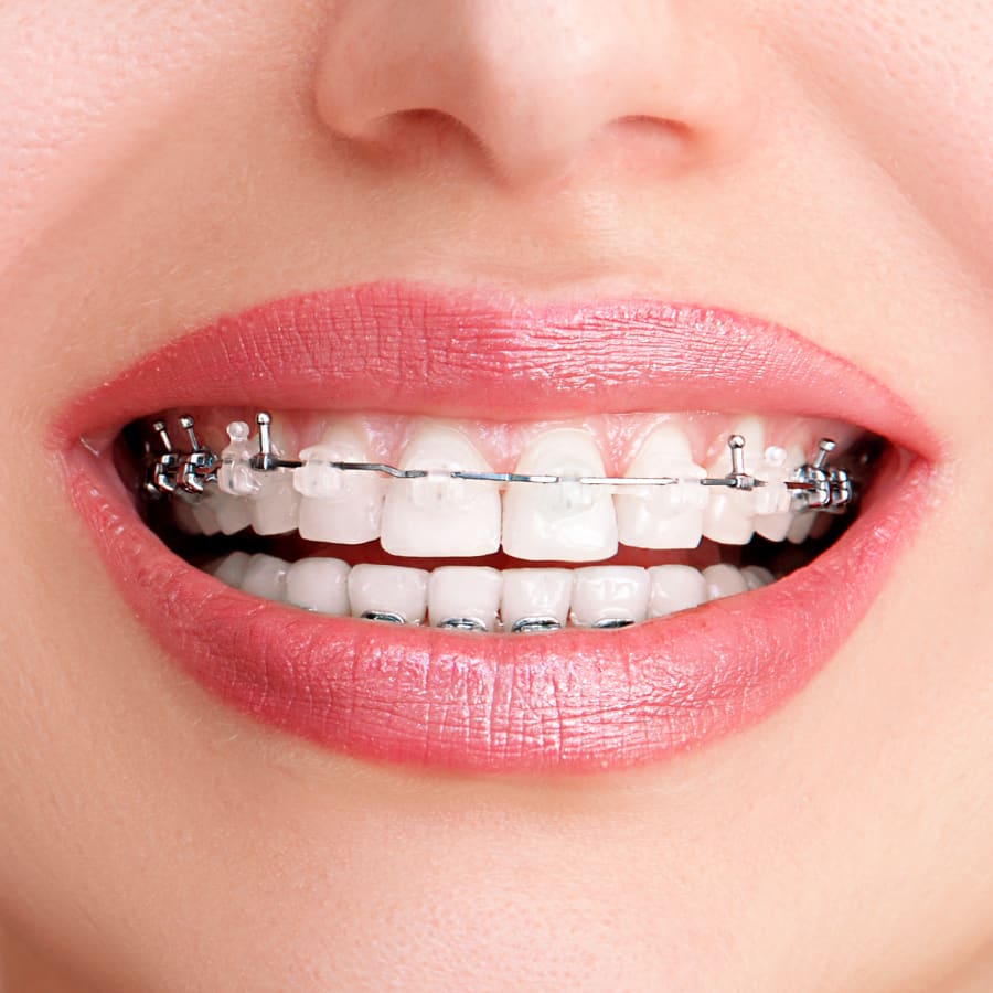 Translucent Braces, Grand Rapids Orthodontist